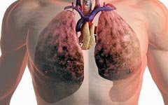 Ученые ищут способ предотвратить развитие рецидива рака легких 
