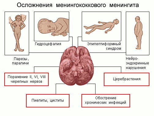 Реферат: Менингит