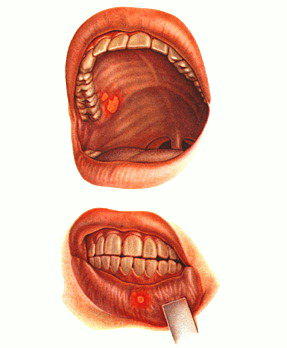 Реферат: Аллергические стоматиты